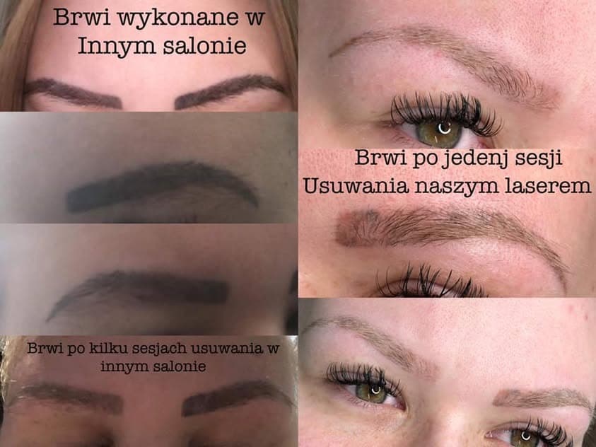 Usuwanie laserowe PMU i tatuażu